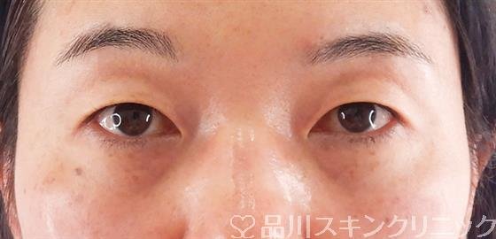 症例NO.57711のBEFORE写真