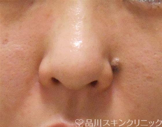 症例NO.35541のBEFORE写真