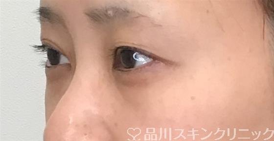 症例NO.54062のBEFORE写真