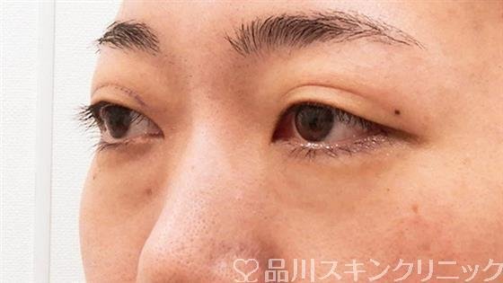 症例NO.61696のBEFORE写真