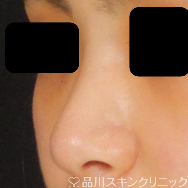 症例NO.66096のBEFORE写真