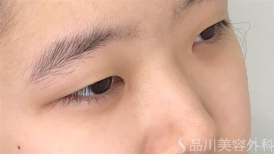 症例NO.57178のBEFORE写真