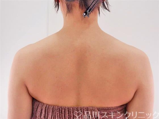 症例NO.60634のBEFORE写真