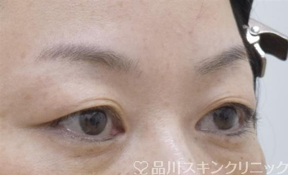 症例NO.59787のBEFORE写真