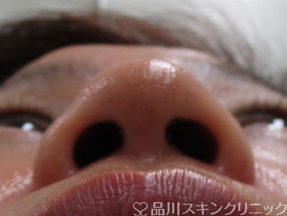 症例NO.52987のBEFORE写真