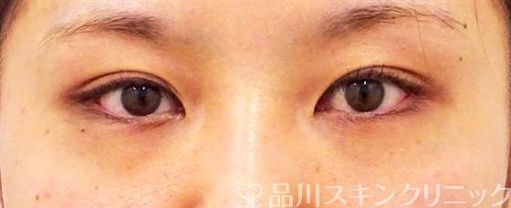 症例NO.50914のBEFORE写真