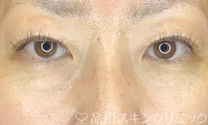 症例NO.65990のBEFORE写真