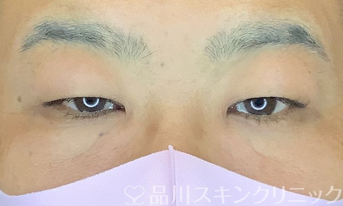 症例NO.65921のBEFORE写真