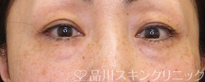 症例NO.63200のBEFORE写真