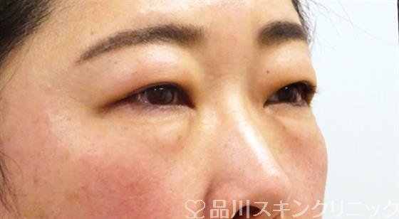 症例NO.52707のBEFORE写真