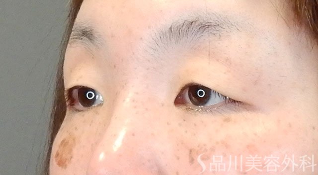 症例NO.64481のBEFORE写真