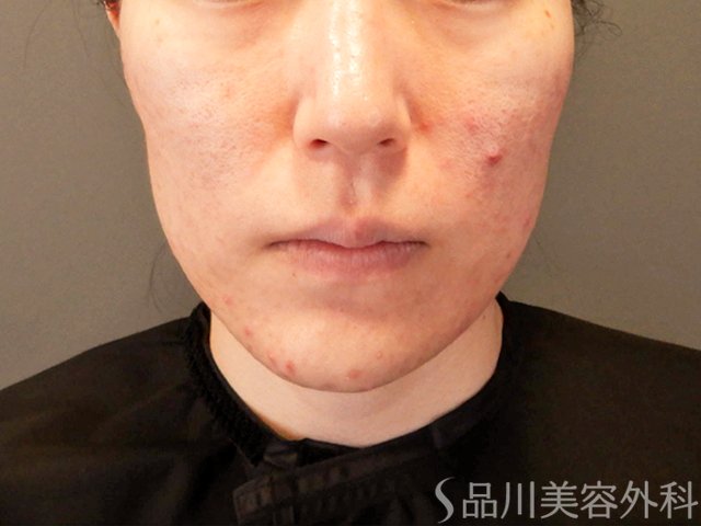 症例NO.67830のBEFORE写真