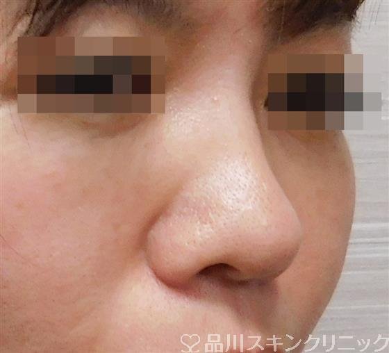 症例NO.49186のBEFORE写真