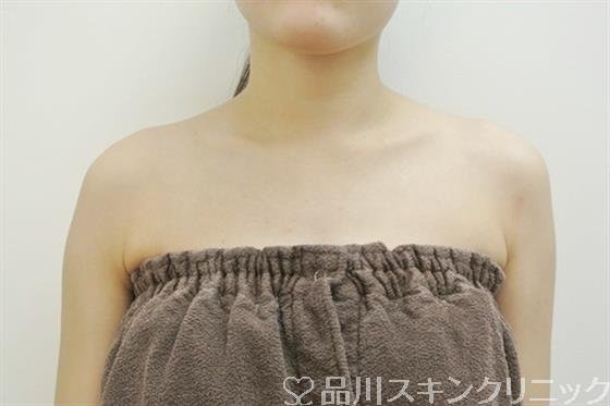 症例NO.28527のBEFORE写真