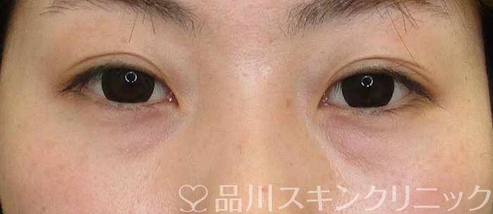 症例NO.63309のBEFORE写真