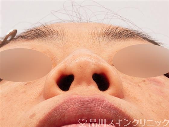 症例NO.54868のBEFORE写真