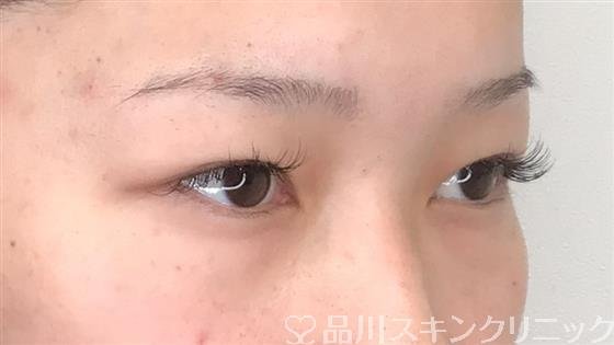 症例NO.58582のBEFORE写真