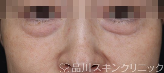 症例NO.64994のBEFORE写真