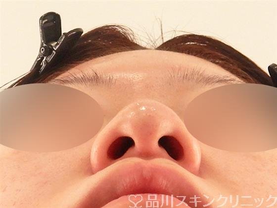 症例NO.58216のBEFORE写真