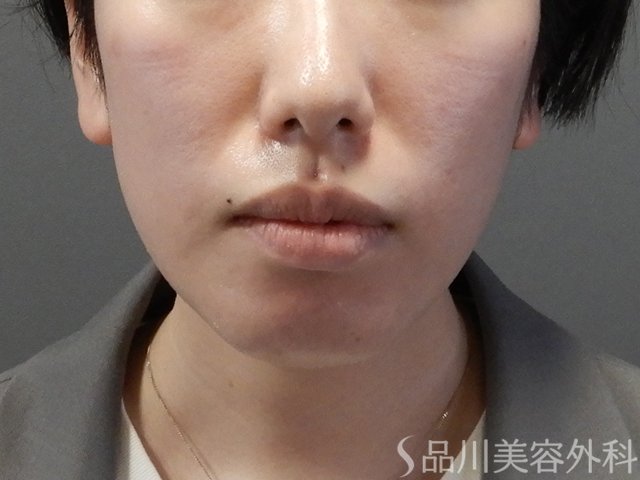 症例NO.64460のBEFORE写真