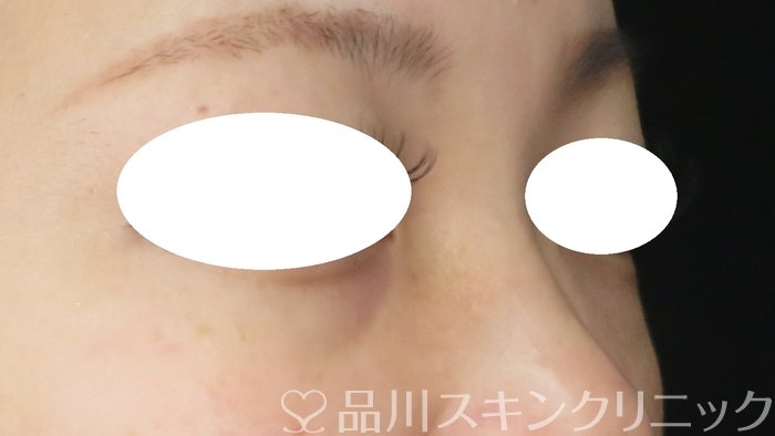 症例NO.66010のBEFORE写真