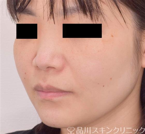 症例NO.61686のBEFORE写真