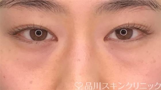 症例NO.54836のBEFORE写真