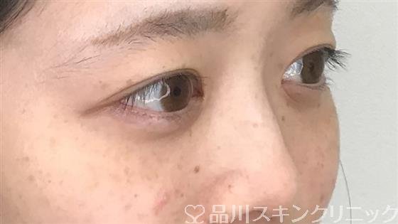 症例NO.57179のBEFORE写真