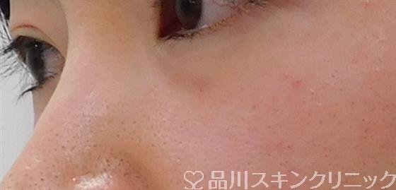 症例NO.40992のBEFORE写真