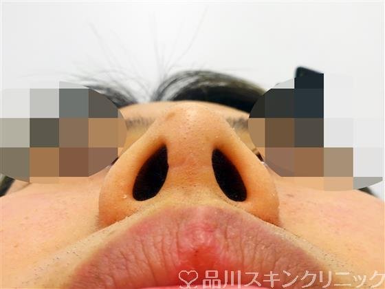 症例NO.45707のBEFORE写真