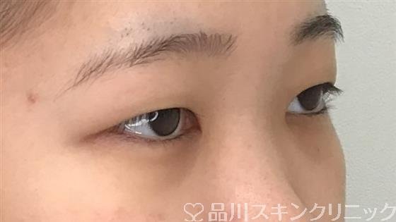 症例NO.56620のBEFORE写真