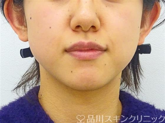 症例NO.45878のBEFORE写真