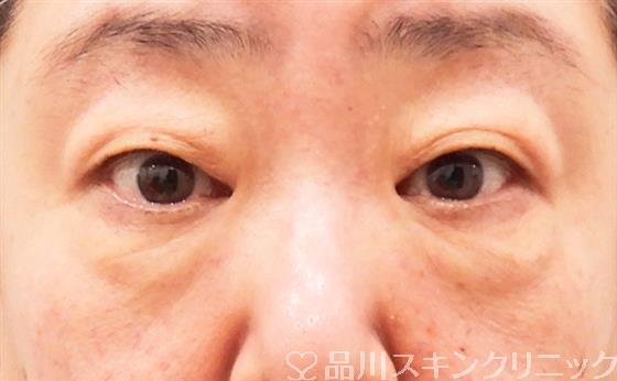 症例NO.61960のBEFORE写真