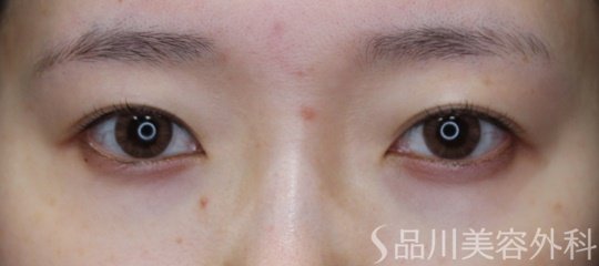 症例NO.67470のBEFORE写真