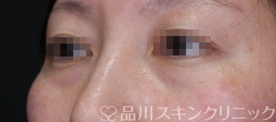 症例NO.65378のBEFORE写真