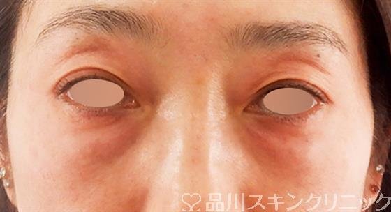 症例NO.58730のBEFORE写真