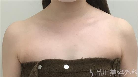 症例NO.55489のBEFORE写真