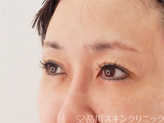 症例NO.59096のBEFORE写真