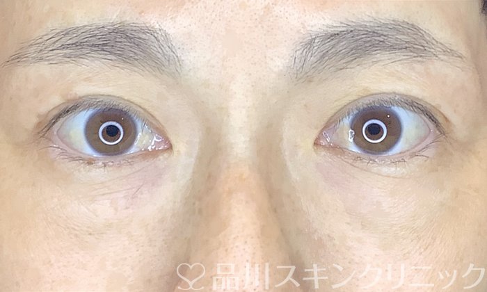 症例NO.66439のBEFORE写真