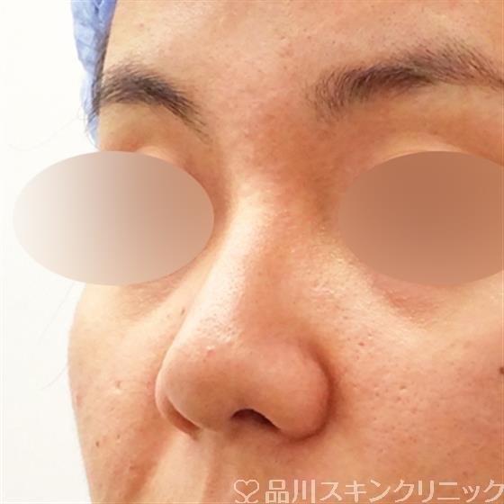 症例NO.53528のBEFORE写真