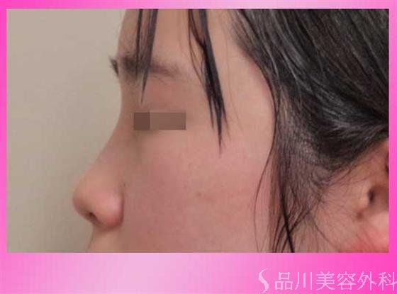 症例NO.38715のBEFORE写真