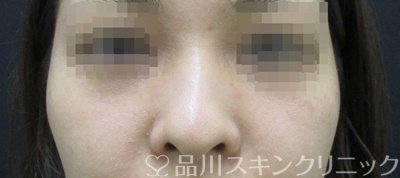 症例NO.67316のBEFORE写真