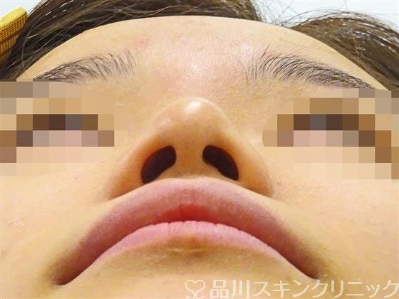 症例NO.44533のBEFORE写真