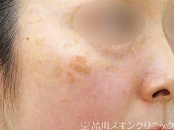 症例NO.50627のBEFORE写真