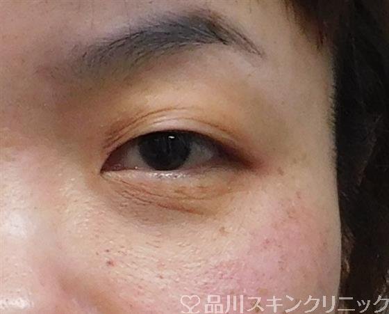 症例NO.48205のBEFORE写真