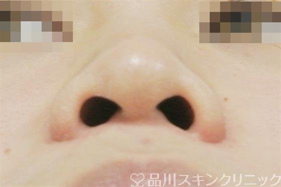 症例NO.37540のBEFORE写真