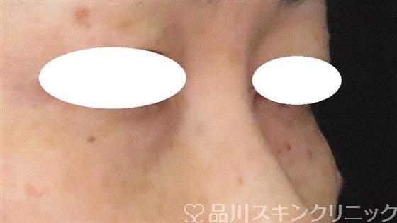 症例NO.56645のBEFORE写真