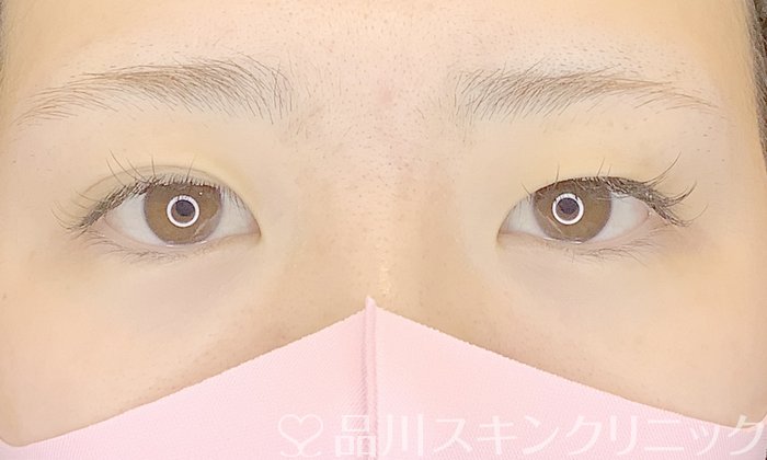 症例NO.66500のBEFORE写真