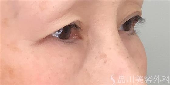 症例NO.53993のBEFORE写真