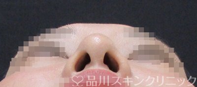 症例NO.67316のAFTER写真